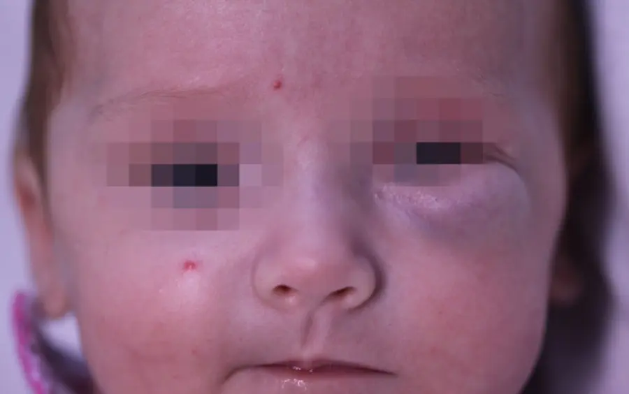 I vantaggi del propranololo nella cura degli emangiomi