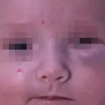 I vantaggi del propranololo nella cura degli emangiomi