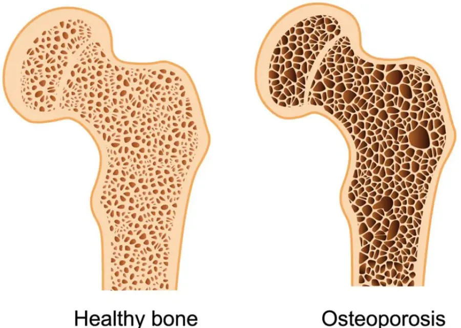 Osteoporosi: Cause e cura