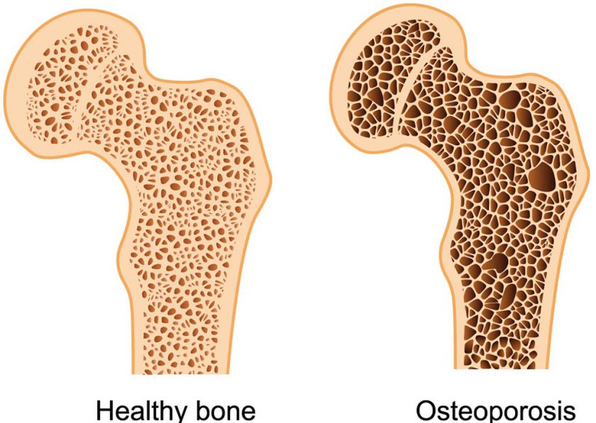 Osteoporosi: Cause e cura
