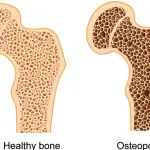 Osteoporosi: Cause e cura