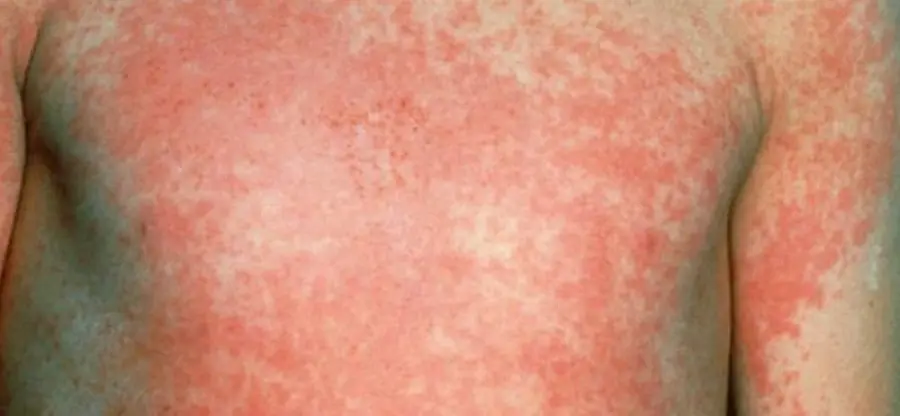La Scarlattina cos'è? sintomi e cura
