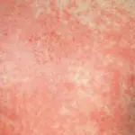 La Scarlattina cos'è? sintomi e cura