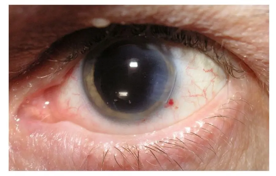 Chirurgia cataratta: in che cosa consiste