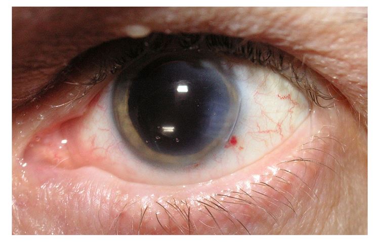 Chirurgia cataratta: in che cosa consiste