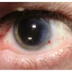 Chirurgia cataratta: in che cosa consiste