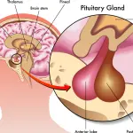 Perdere peso con la stimolazione dell’Ipofisi